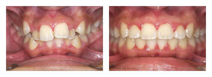 Patient - Overcrowding of teeth, before and after